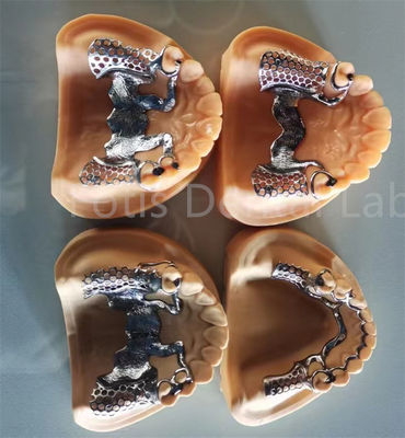 Rửa răng linh hoạt có thể tháo rời một phần với sự ổn định lâu dài và thoải mái điều chỉnh
