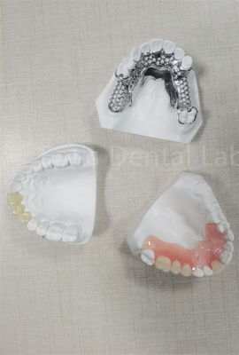 Chất thay thế răng bị mất dễ dàng