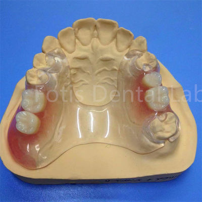 Dễ dàng làm sạch và điều chỉnh bộ răng giả một phần bền vững thoải mái