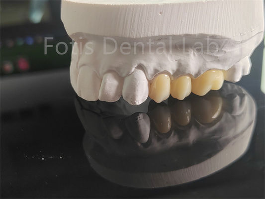 Tăng cường cao Full Porcelain Layered Zirconia cho vương miện răng