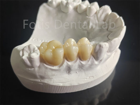 Chống mài mòn Zirconia lớp với vật liệu nha khoa sứ