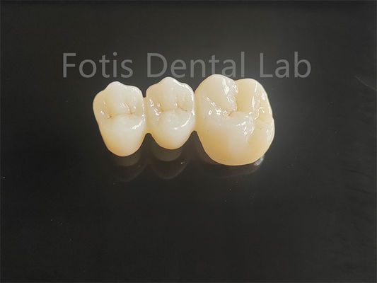 Tăng cường cao porcelain lớp Zirconia cho lâu dài răng cầu