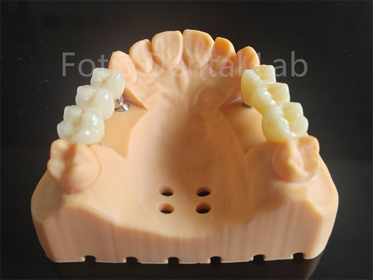Tùy chỉnh Full Contour Zirconia lớp với vật liệu nha khoa sứ