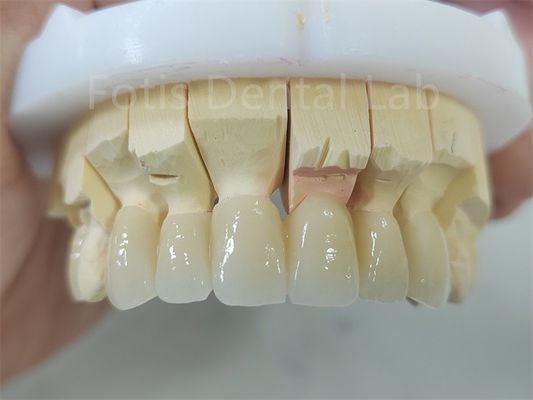 Sản phẩm nha khoa Zirconia lớp với đồ sứ Bảo trì dễ dàng