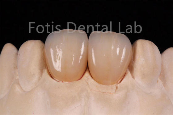 Zirconia nhiều lớp xuyên suốt cao để chế tạo các bộ phận nha khoa