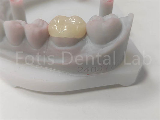 OEM răng Inlay và Onlay Ceramic phục hồi và răng màu đầy