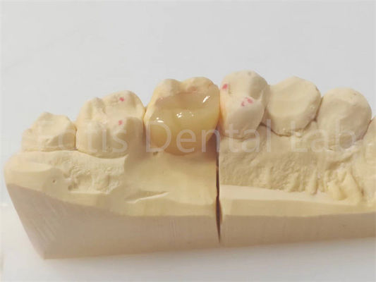 Đặt răng chính xác và đặt răng để phục hồi chính xác và lâu dài