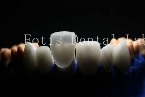 Các tấm veneer nhựa nhựa nhựa dài và bền với vật liệu sứ
