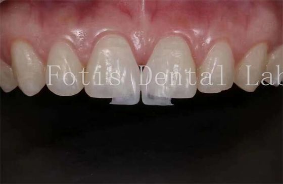 Laminate Laboratory Laminate High Translucency Dental Veneers cho tự nhiên và bóng