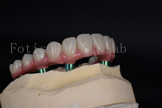 Phương pháp cấy ghép nâng cao phục hồi khả năng nhai đầy đủ cho bệnh nhân có mật độ xương thấp