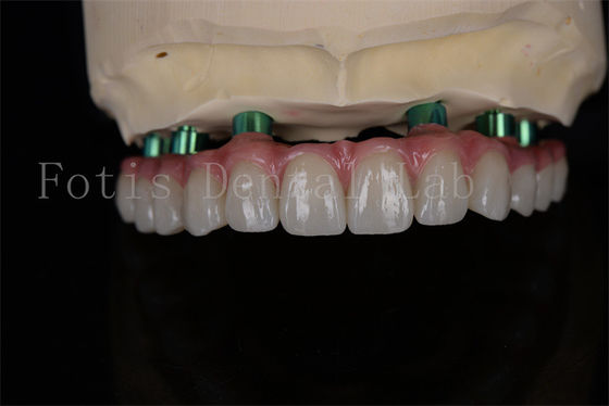 Tiến trình cấy ghép Zirconia All-on-4 cùng ngày phục hồi Tiếp theo tối thiểu cần thiết
