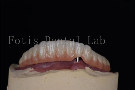 Thiết bị cấy ghép răng Titanium hoặc Zirconia trông tự nhiên Tiến pháp xâm lấn tối thiểu Dễ lau