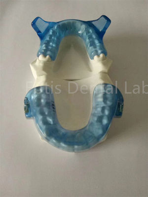 Thiết bị chỉnh răng tiên tiến cho kết quả sắp xếp răng tốt hơn